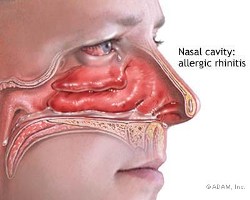 Allergic rhinitis