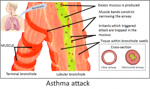 Asthma trigger